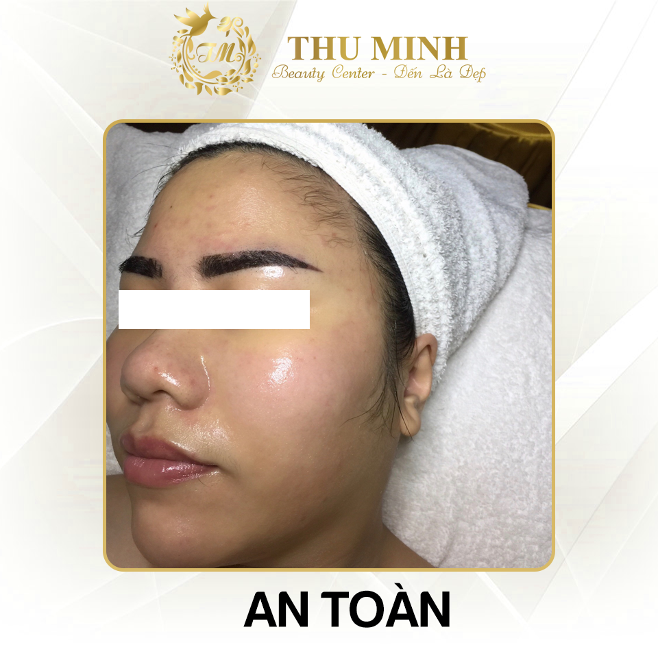 [Cập nhật 2020] Tiêm căng bóng da mặt giá bao nhiêu